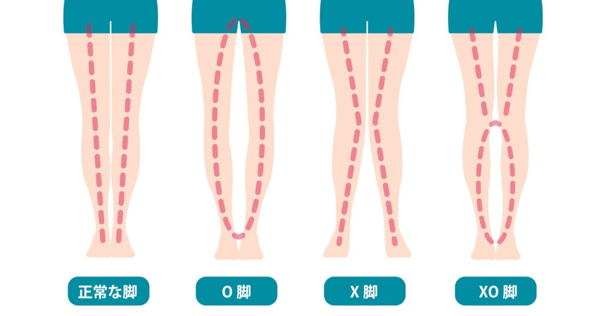 O脚を治せば身長が伸びる？原因・改善方法とおすすめグッズ4選！