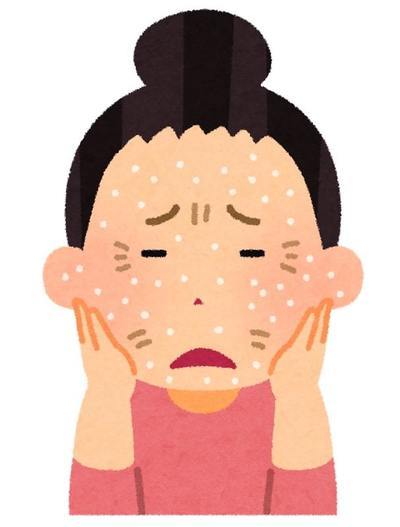 顔の皮むけは乾燥が原因！対策におすすめの化粧品9選紹介！