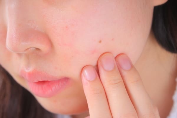 ほくろがある位置の意味とは？知って得する幸運のほくろ占いと雑学