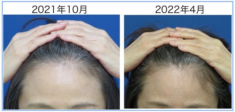 女性の薄毛治療、編集部が6ケ月ためした！毛は生えてきたか？