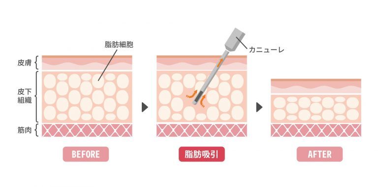 「脂肪吸引って怖くない？」自分も体験した美容外科医が答えます